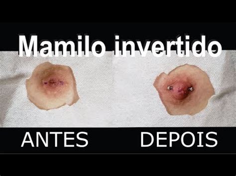 Mamilo ou bico do seio invertido